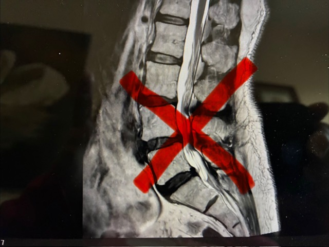 spine